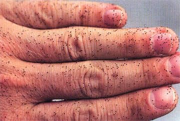 Bird Mite Infestation Treatment